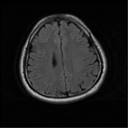File:Acoustic schwannoma (Radiopaedia 33045-34060 Axial FLAIR 16).png