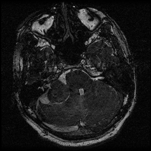 File:Acoustic schwannoma (Radiopaedia 39170-41387 Axial FIESTA 73).png