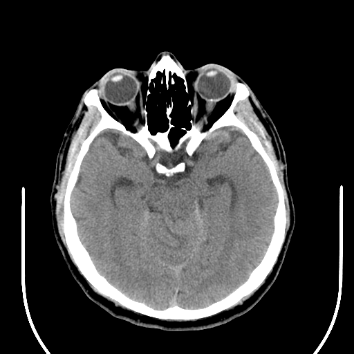 File:Acoustic schwannoma (Radiopaedia 39170-41388 Axial non-contrast 19).png