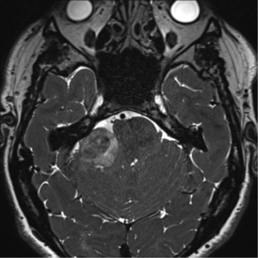 File:Acoustic schwannoma (Radiopaedia 50846-56358 Axial T2 27).png