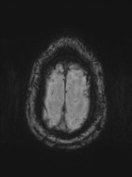 File:Acoustic schwannoma (Radiopaedia 55729-62281 Axial SWI 48).png