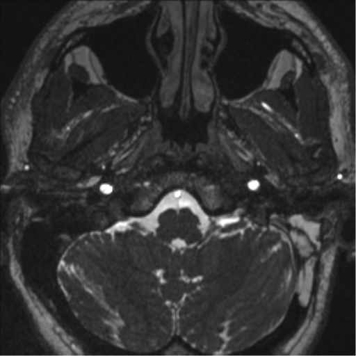 Acoustic schwannoma (translabyrinthine resection) (Radiopaedia 43570-46972 Axial CISS 11).png