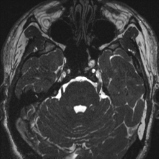 Acoustic schwannoma (translabyrinthine resection) (Radiopaedia 43570-46972 Axial CISS 40).png