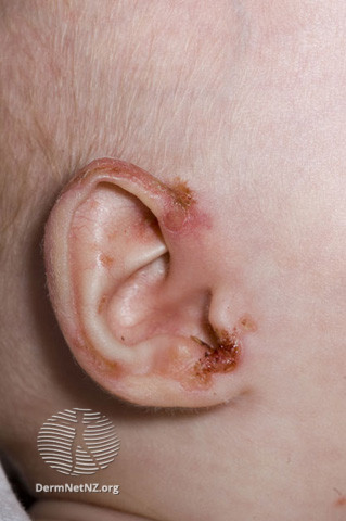 File:Acrodermatitis enteropathica (DermNet NZ systemic-acroderm2).jpg