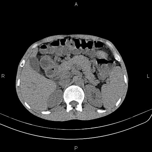 Active crohn disease (Radiopaedia 87133-103397 Axial non-contrast 30).jpg