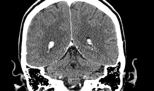 File:Active neurocysticercosis before and after therapy (Radiopaedia 71710-82099 Coronal 18).jpg