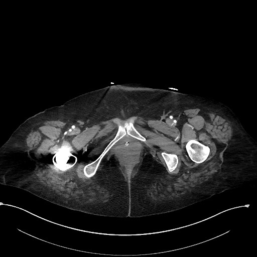 File:Active renal extravasation with large subcapsular and retroperitoneal hemorrhage (Radiopaedia 60975-68796 Axial 190).jpg