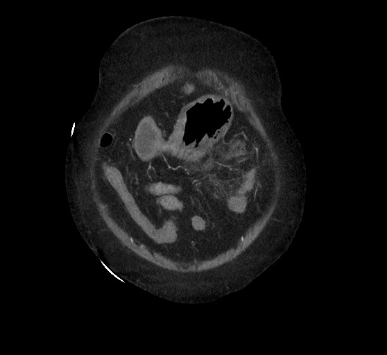 Active renal extravasation with large subcapsular and retroperitoneal hemorrhage (Radiopaedia 60975-68796 Coronal C+ arterial phase 28).jpg