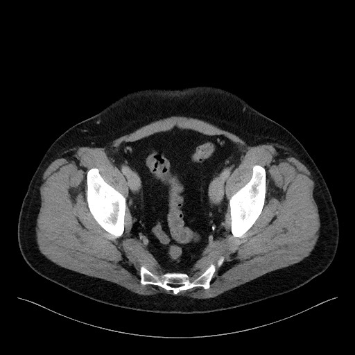 Acute-on-chronic pancreatitis (Radiopaedia 67286-76656 Axial C+ portal venous phase 71).jpg