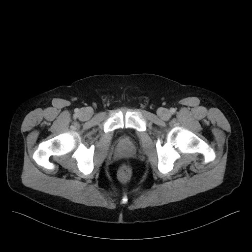 Acute-on-chronic pancreatitis (Radiopaedia 67286-76656 Axial C+ portal venous phase 83).jpg