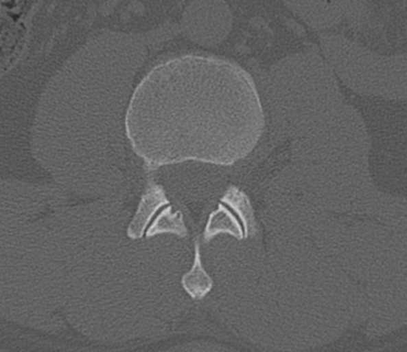 File:Acute L1 burst compression fracture (Radiopaedia 34430-35755 Axial bone window 43).png