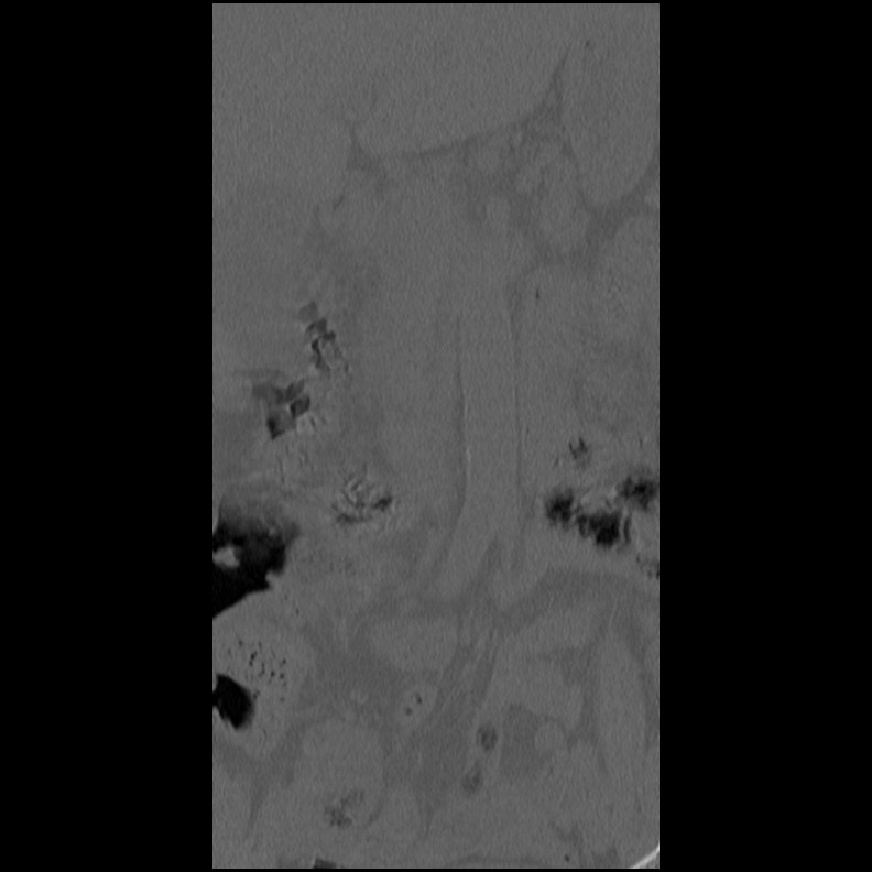 Acute Schmorl's node (Radiopaedia 83276-102365 Coronal bone window 5).jpg