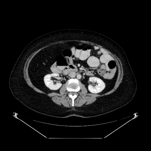 Acute appendicitis, heterotaxy syndrome (Radiopaedia 66884-76202 Axial C+ portal venous phase 58).jpg