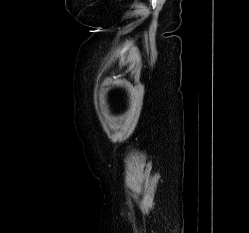 Acute appendicitis, heterotaxy syndrome (Radiopaedia 66884-76202 Sagittal C+ portal venous phase 119).jpg