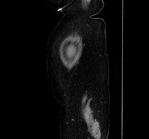 Acute appendicitis, heterotaxy syndrome (Radiopaedia 66884-76202 Sagittal C+ portal venous phase 16).jpg
