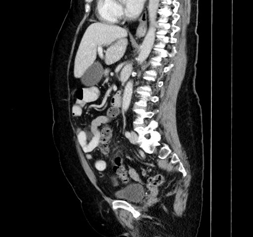 Acute appendicitis, heterotaxy syndrome (Radiopaedia 66884-76202 Sagittal C+ portal venous phase 76).jpg