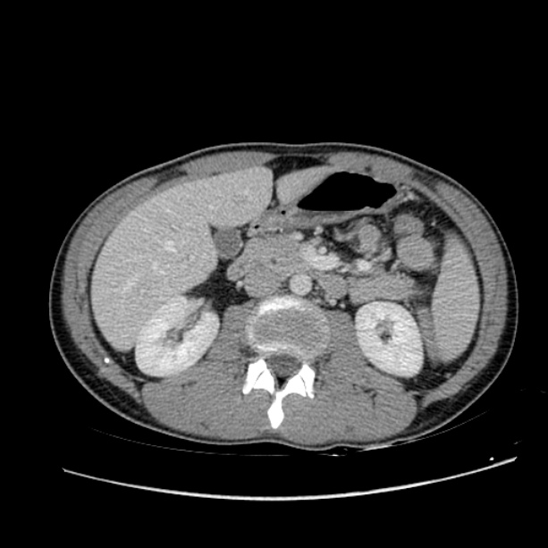 Acute appendicitis (Radiopaedia 27049-27227 Axial C+ portal venous phase 29).jpg