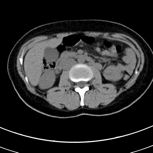 Acute appendicitis (Radiopaedia 30261-30888 Axial non-contrast 32).jpg