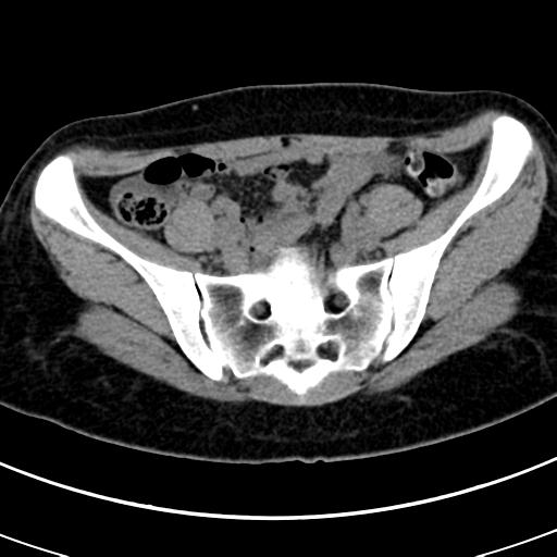 Acute appendicitis (Radiopaedia 30261-30888 Axial non-contrast 75).jpg
