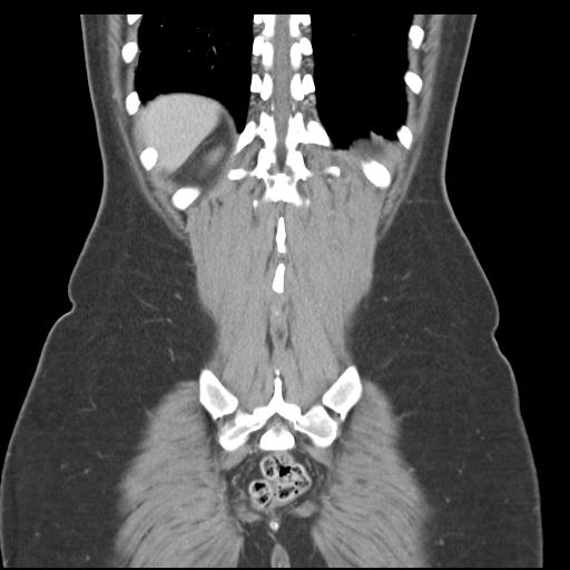 Acute appendicitis (Radiopaedia 30297-30934 Coronal C+ portal venous phase 40).jpg