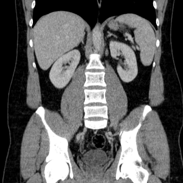 Acute appendicitis (Radiopaedia 38255-40270 Coronal C+ portal venous phase 54).jpg