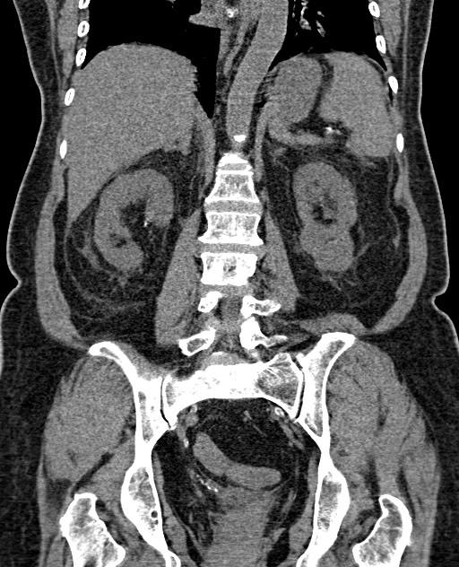 Acute appendicitis (Radiopaedia 58627-65818 Coronal non-contrast 48).jpg