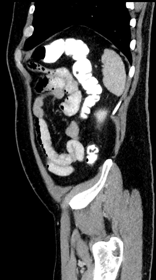 Acute appendicitis (Radiopaedia 77016-88960 Sagittal C+ portal venous phase 21).jpg