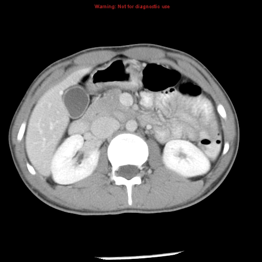 Acute appendicitis (Radiopaedia 8195-9045 Axial C+ portal venous phase 28).jpg