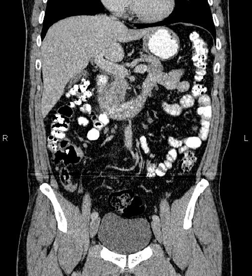 Acute appendicitis (Radiopaedia 84780-100240 Coronal C+ portal venous phase 34).jpg