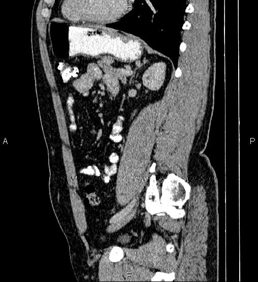 File:Acute appendicitis (Radiopaedia 84780-100240 Sagittal C+ portal venous phase 68).jpg