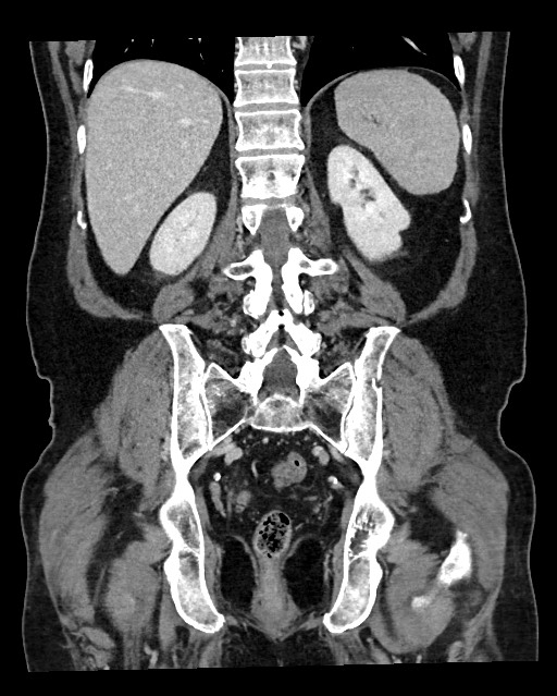 Acute appendicitis - large appendicoliths (Radiopaedia 61805-69820 Coronal C+ portal venous phase 97).jpg
