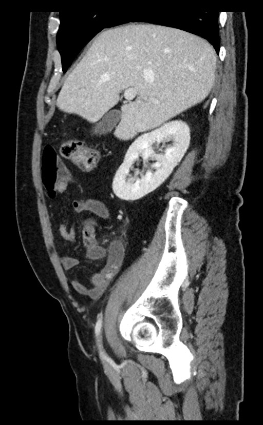 Acute appendicitis - large appendicoliths (Radiopaedia 61805-69820 Sagittal C+ portal venous phase 82).jpg