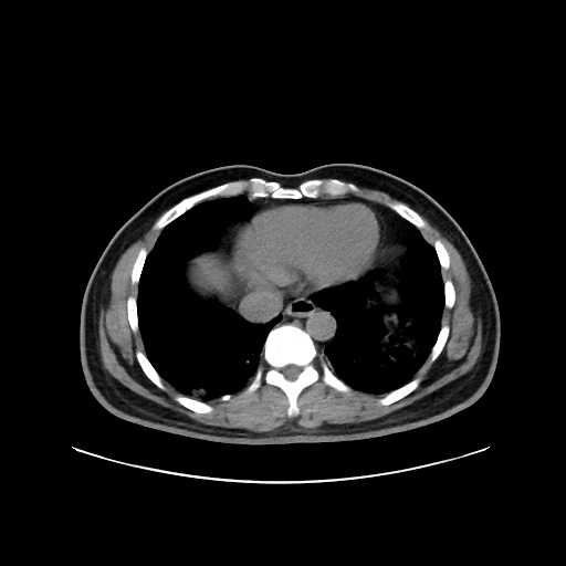 Acute appendicitis and COVID 19 pneumonia (Radiopaedia 76604-88380 Axial non-contrast 42).jpg
