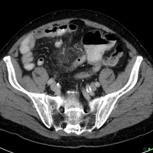 File:Acute appendicitis arising from a malrotated cecum (Radiopaedia 19970-19997 Axial C+ portal venous phase 35).jpg