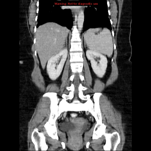 Acute appendicitis complicated by ovarian vein thrombophlebitis (Radiopaedia 16172-15851 Coronal C+ portal venous phase 55).jpg
