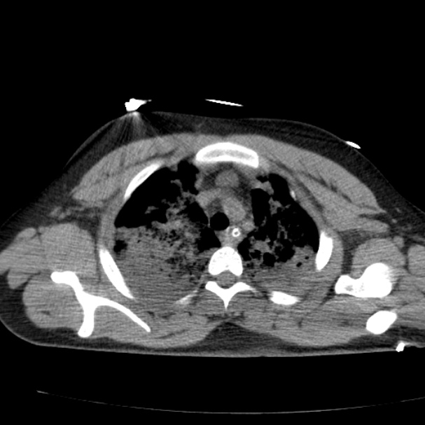 Acute aspiration pneumonitis (Radiopaedia 33605-34703 Axial non-contrast 29).jpg