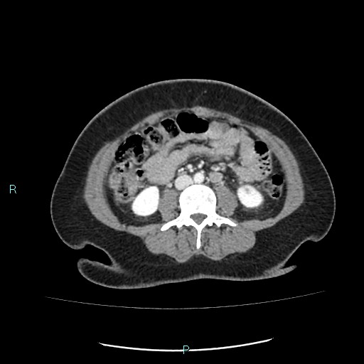Acute bilateral pyelonephritis (Radiopaedia 37146-38881 Axial C+ portal venous phase 57).jpg