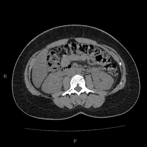 Acute bilateral pyelonephritis (Radiopaedia 37146-38881 Axial non-contrast 50).jpg