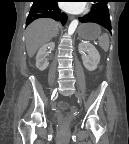 File:Acute bleed from gastric fundus biopsy site (Radiopaedia 35201-36737 Coronal C+ arterial phase 35).png