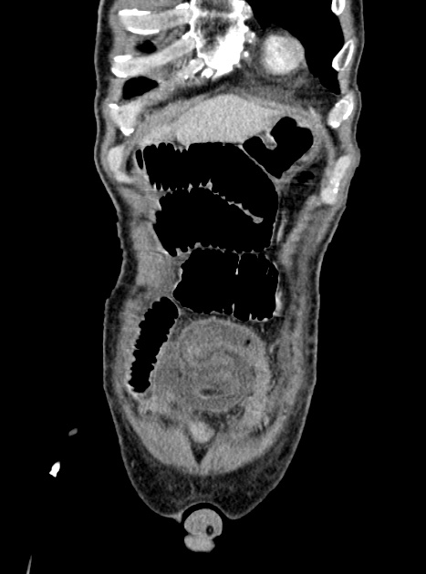 Acute bowel ischemia (Radiopaedia 87695-104114 Coronal C+ portal venous phase 93).jpg