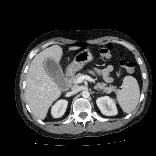 Acute cholecystitis and incidental left sided IVC (Radiopaedia 49352-54459 Axial C+ portal venous phase 54).jpg
