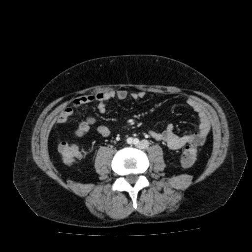 File:Acute cholecystitis and incidental left sided IVC (Radiopaedia 49352-54459 Axial C+ portal venous phase 91).jpg
