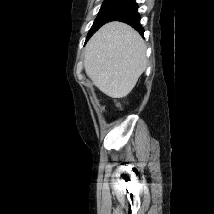 Acute cholecystitis and incidental left sided IVC (Radiopaedia 49352-54459 Sagittal C+ portal venous phase 76).jpg