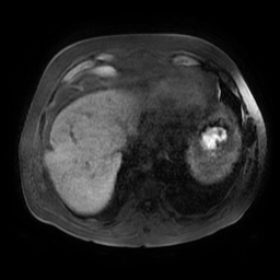 Acute cholecystitis complicated by pylephlebitis (Radiopaedia 65782-74915 Axial T1 fat sat 8).jpg