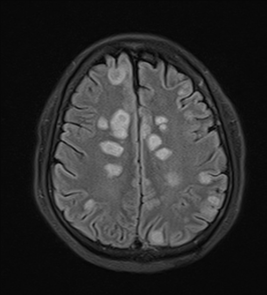 File:Acute disseminated encephalomyelitis (Radiopaedia 37253-39033 Axial FLAIR 19).jpg