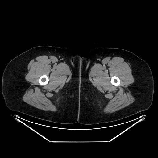 Acute diverticulitis - transverse colon (Radiopaedia 87063-103327 Axial C+ portal venous phase 196).jpg