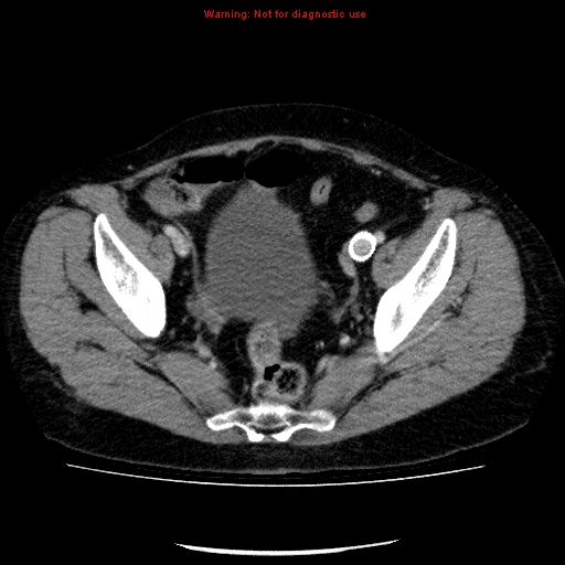 Acute gangrenous cholecystitis (Radiopaedia 10123-10661 Axial C+ portal venous phase 87).jpg