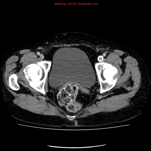 File:Acute gangrenous cholecystitis (Radiopaedia 10123-10661 Axial C+ portal venous phase 96).jpg