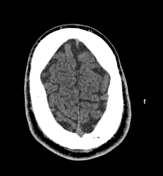 Acute ischemic stroke - posterior circulation territory (Radiopaedia 77670-89881 non-contrast 81).jpg
