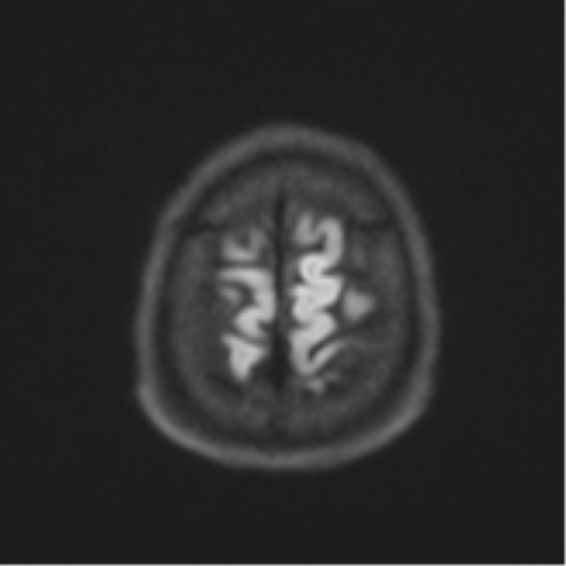 Acute left middle cerebral artery territory infarct with clot retrieval (Radiopaedia 47732-52433 Axial DWI 58).png